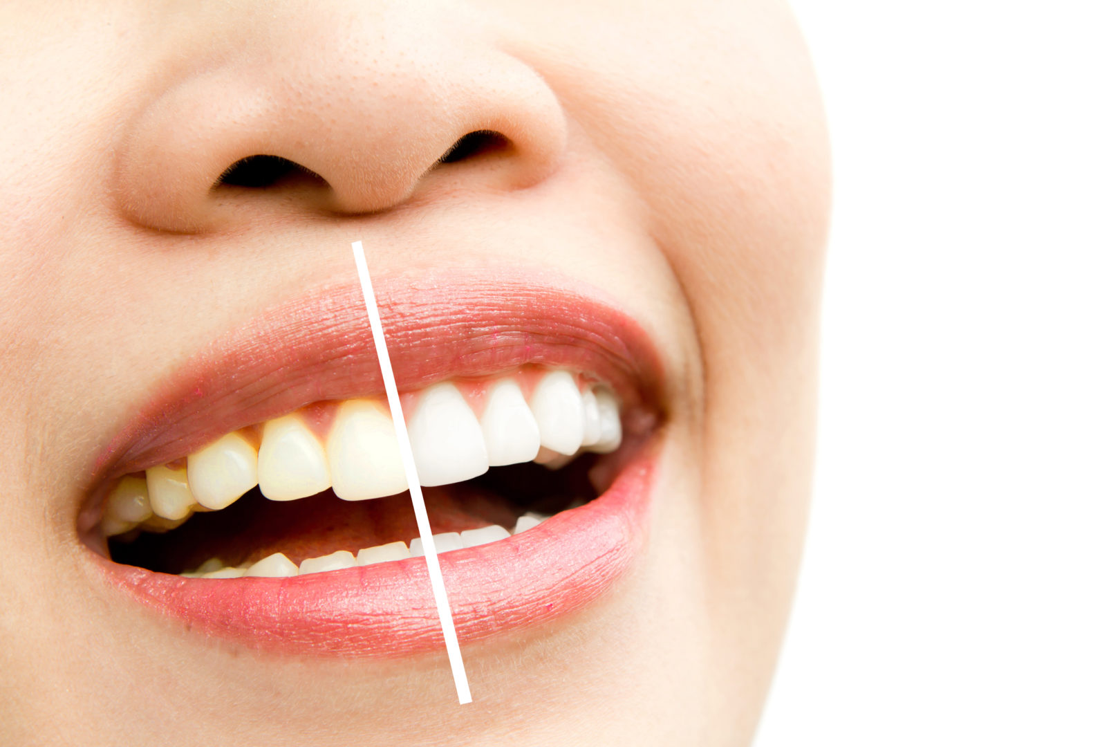 Blanqueamiento Dental: Devuelve El Blanco Natural A Tu Sonrisa