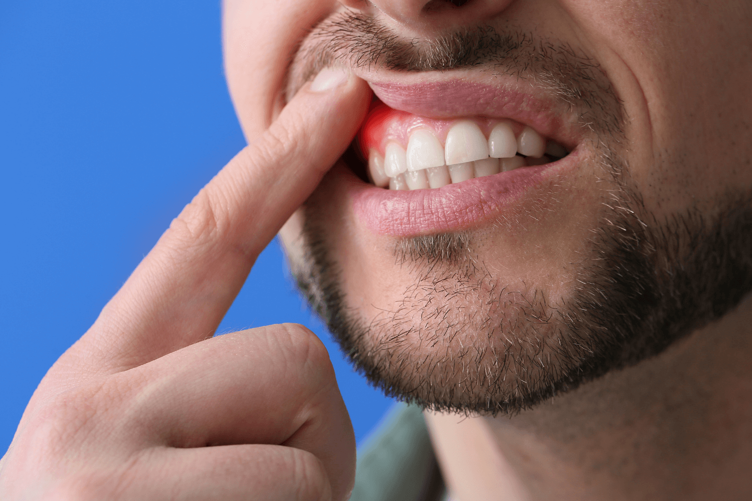 Qué Es La Enfermedad Periodontal