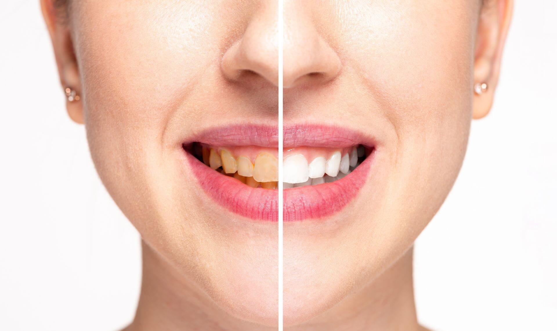 Cómo Tener Los Dientes Blancos